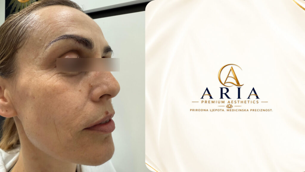 Aria Premium Aestetics - REZULTATI - Prije i Poslije (1)