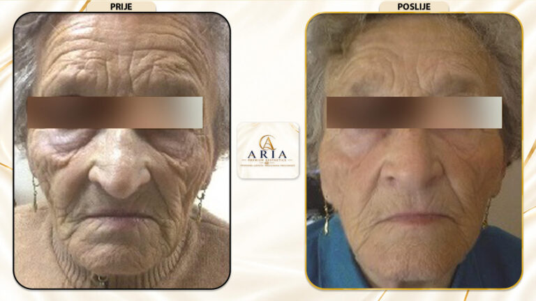 Aria Premium Aestetics - REZULTATI - Prije i Poslije (10)