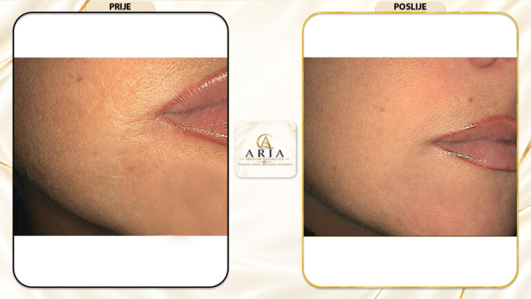 Aria Premium Aestetics - REZULTATI - Prije i Poslije (6)