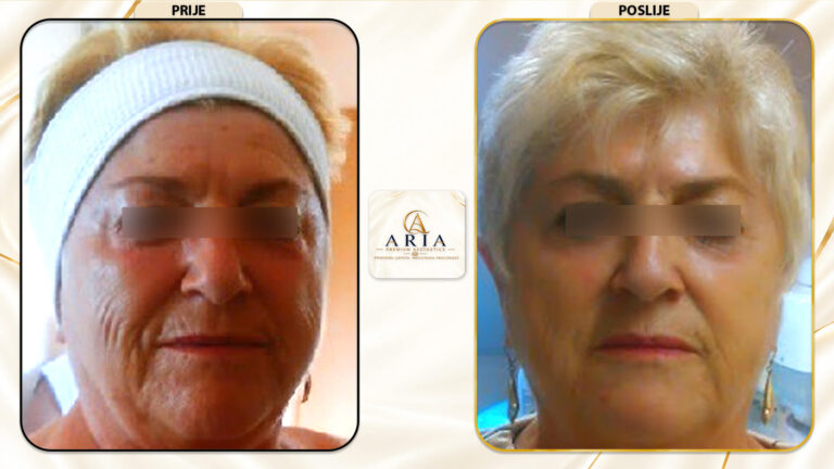 Aria Premium Aestetics - REZULTATI - Prije i Poslije (7)